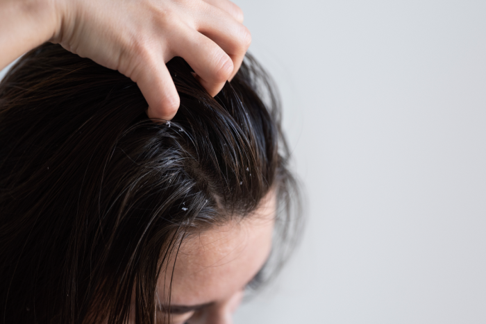 3 gia vị nhà bếp giúp kiểm soát gàu và ngứa da đầu hiệu quả