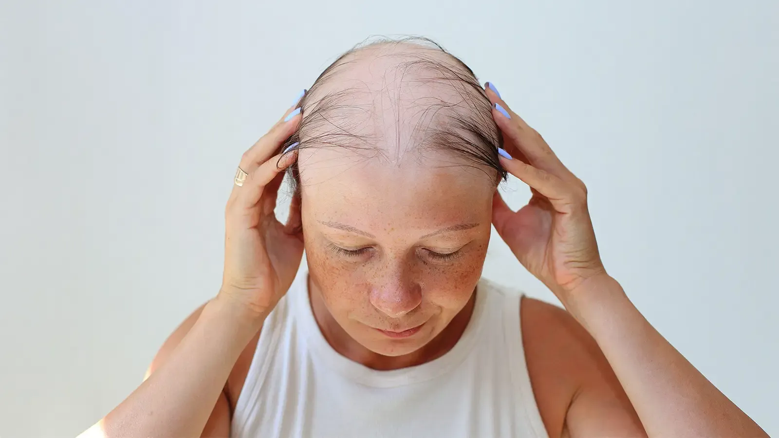 GLP-1 Hair Loss: How Ozempic, Wegovy, Zepbound and Mounjaro Compare