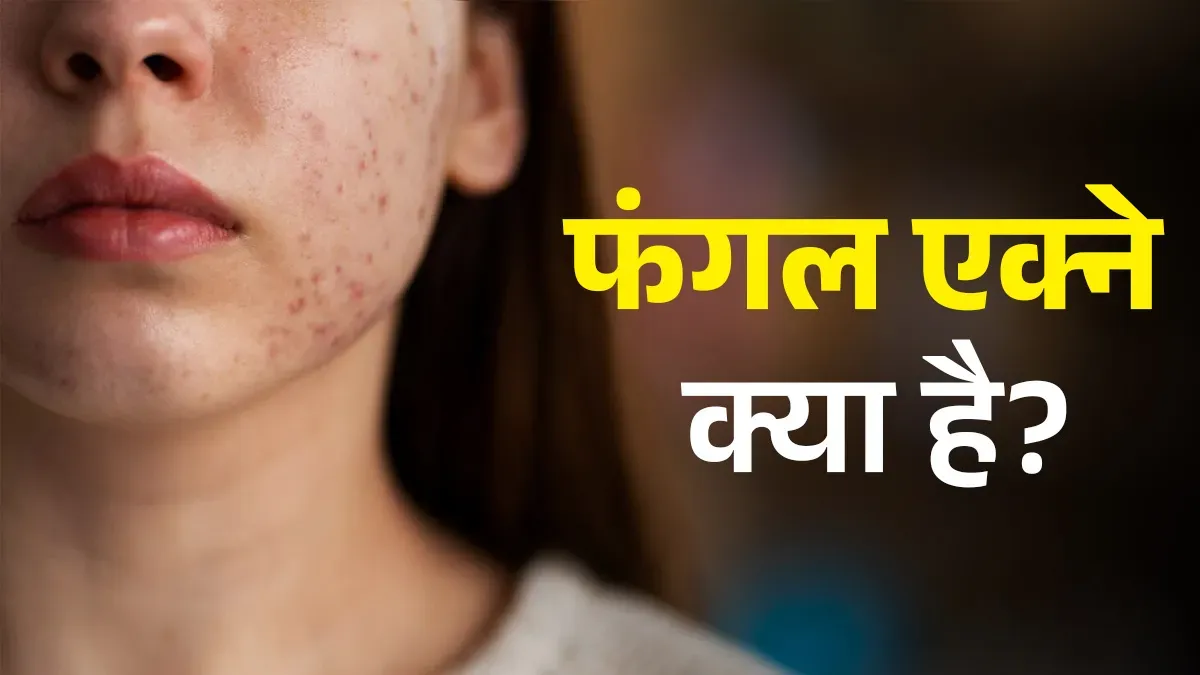 Fungal Acne vs. Bacterial Acne: Why Your Treatment Might Be Backfiring