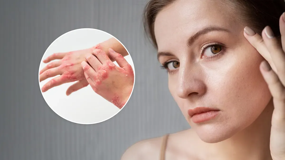 Eczema vs. Dry Skin: How to Tell and Treat the Difference