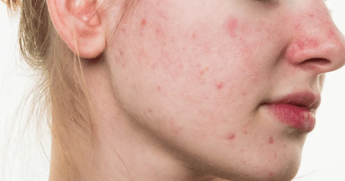 Xử lý mụn viêm đúng cách: làm khô nốt mụn nhưng vẫn bảo vệ da