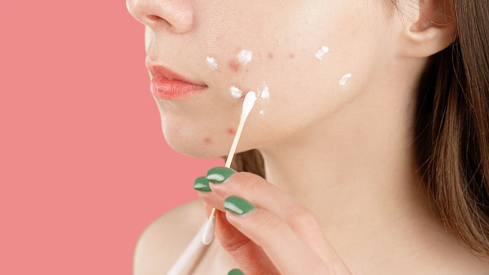 The Complete Spot Treatment Guide: Creams, Gels, and Patches
