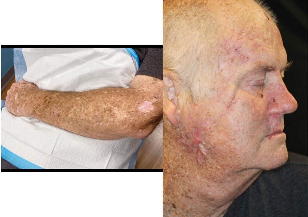 Một lần cháy nắng nặng có thể để lại vết sẹo DNA suốt đời