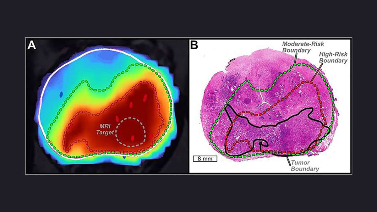 AI Cancer Detection Is Impressive—but Still Awkward in the Clinic