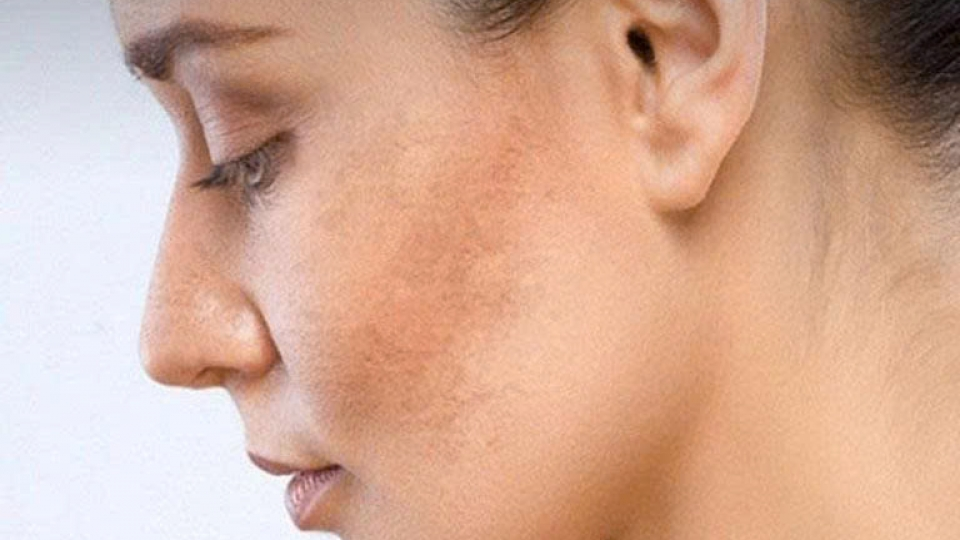 5 thói quen hàng ngày khiến da dễ nám hơn mà bạn chưa biết
