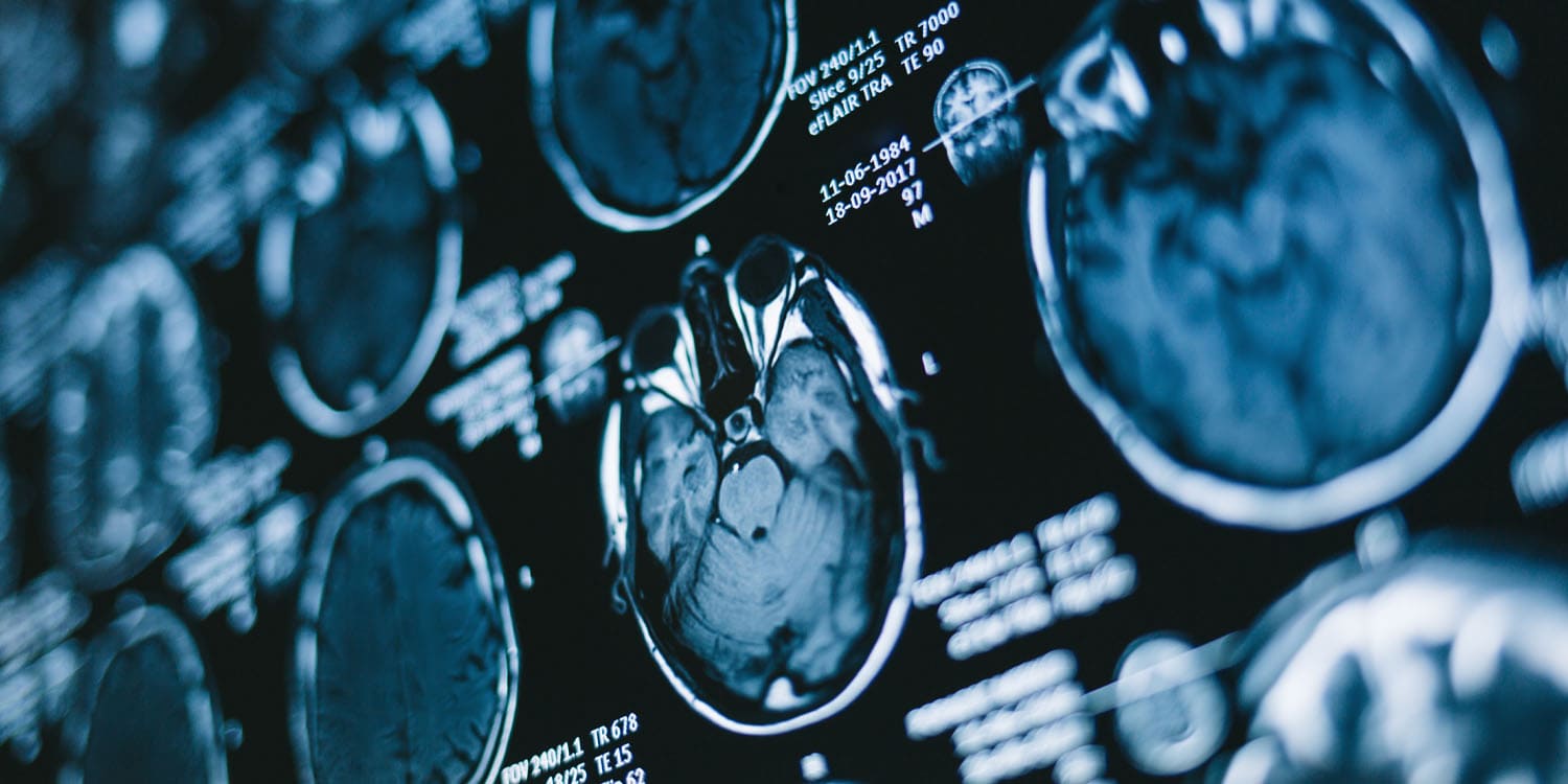 Early Brain Changes in ADHD: What White Matter Tells Us