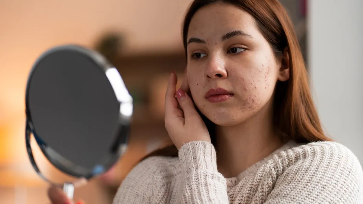 How Stress and Sleep Loss Drive Hormonal Acne Breakouts