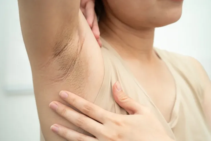 Thâm nách do cạo lông và ma sát: hiểu đúng để làm sáng an toàn