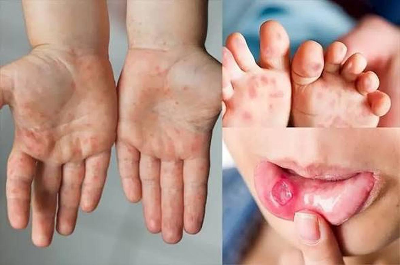 Tay chân miệng tăng 150% khi vào năm học mới: phụ huynh phải hành động ngay