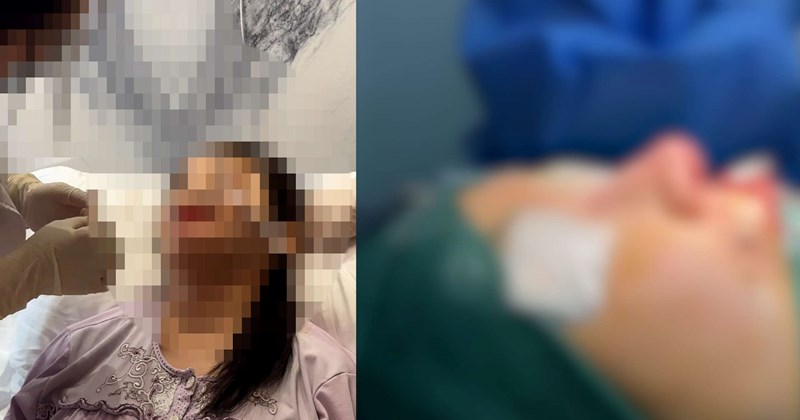 Mũi biến chứng, mắt không nhắm kín: Mặt tối phẫu thuật thẩm mỹ nước ngoài