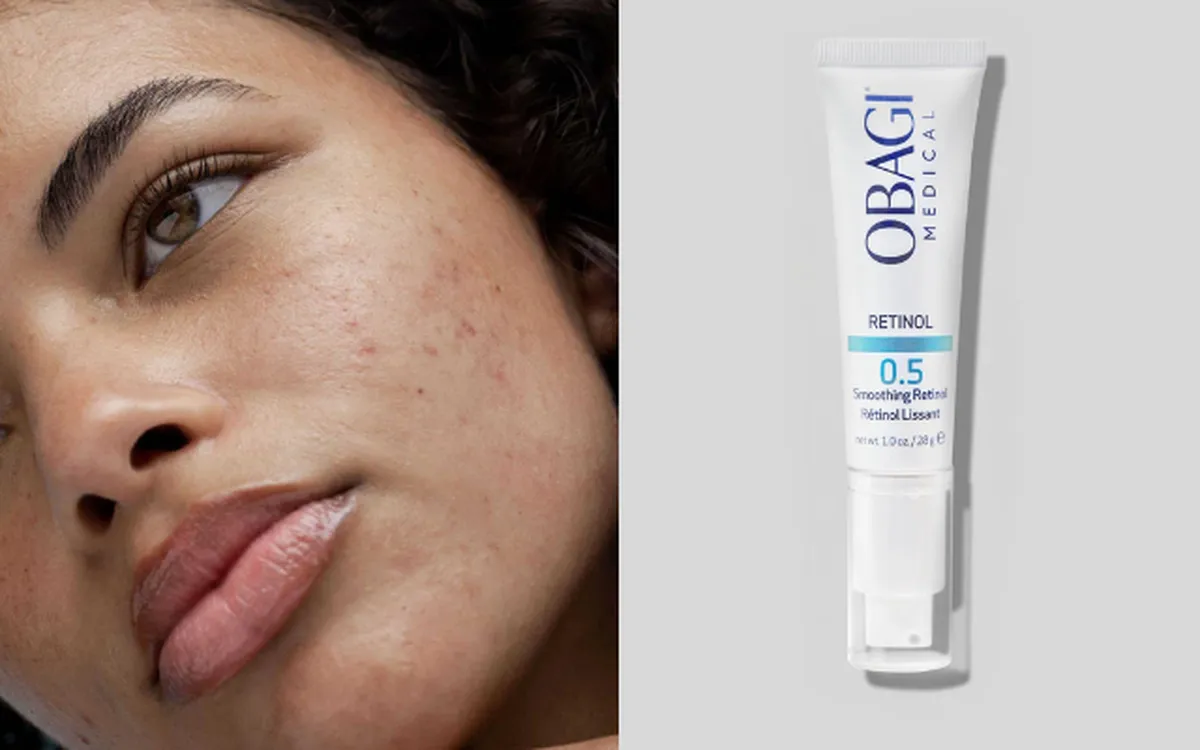 Retinol cho da mụn: Cách dùng đúng để da quen mà không kích ứng