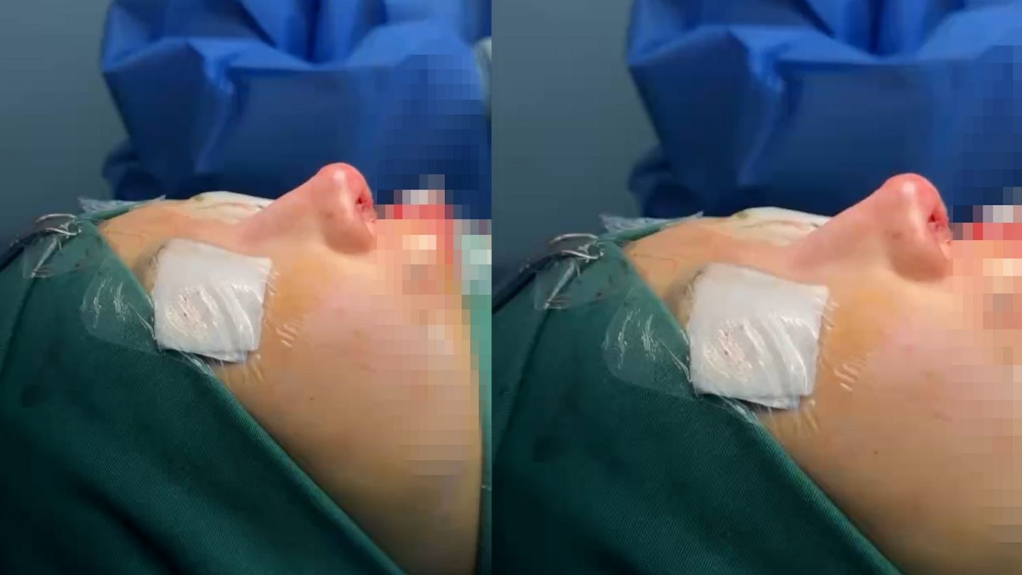 Phẫu thuật mi tại cơ sở không phép: cái giá của sự chủ quan