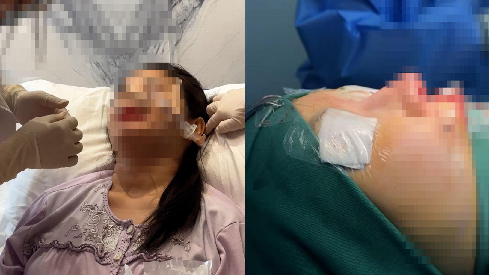 Phẫu thuật mi tại cơ sở không phép: cái giá của sự chủ quan