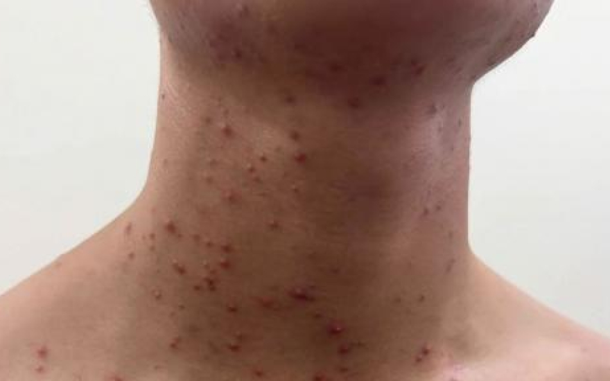 Những nguy hiểm khi tự ý dùng kem trị mụn không theo chỉ định