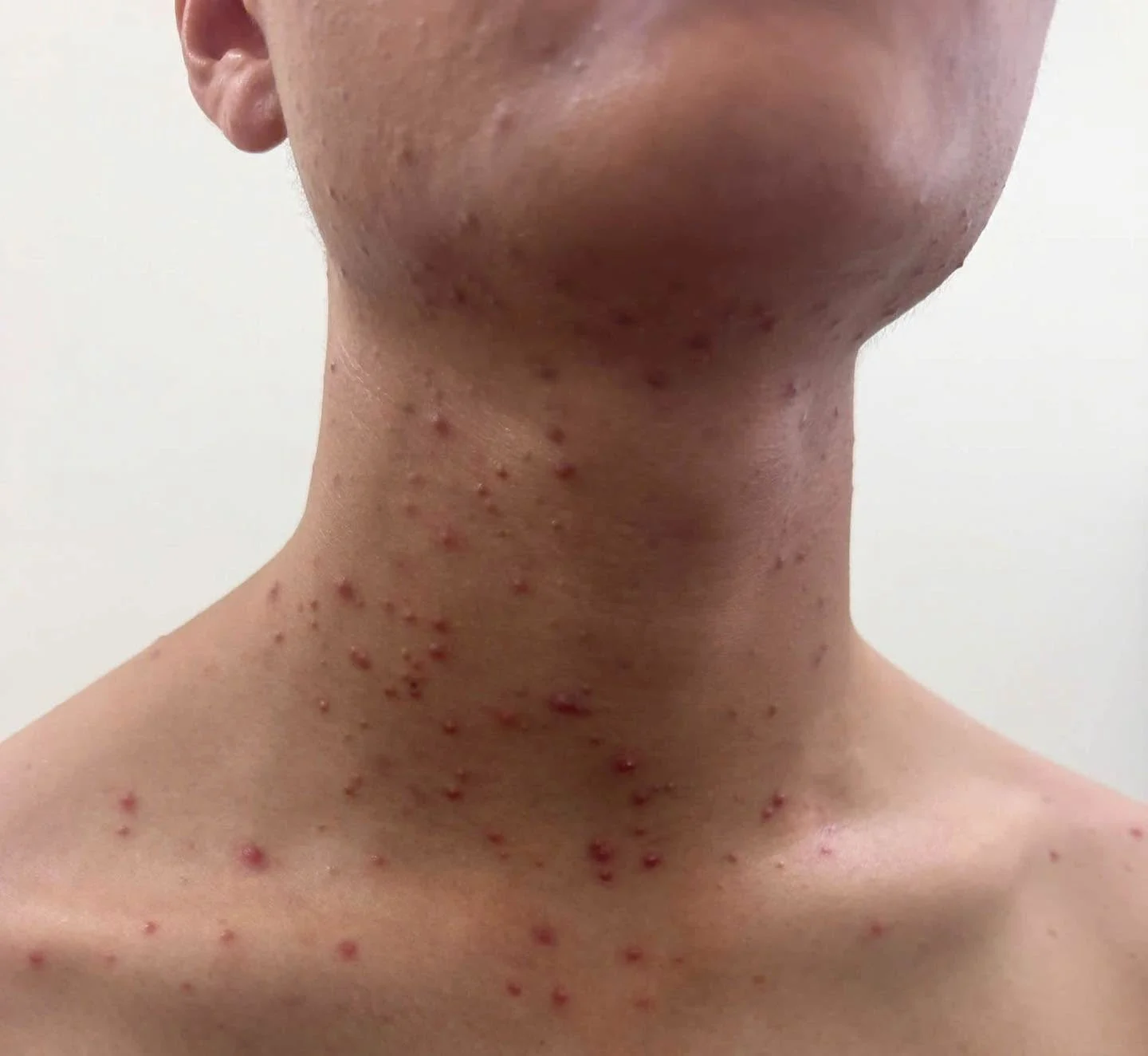 Sử dụng kem trị mụn sai cách: Rủi ro bị bỏ qua và cách dùng an toàn