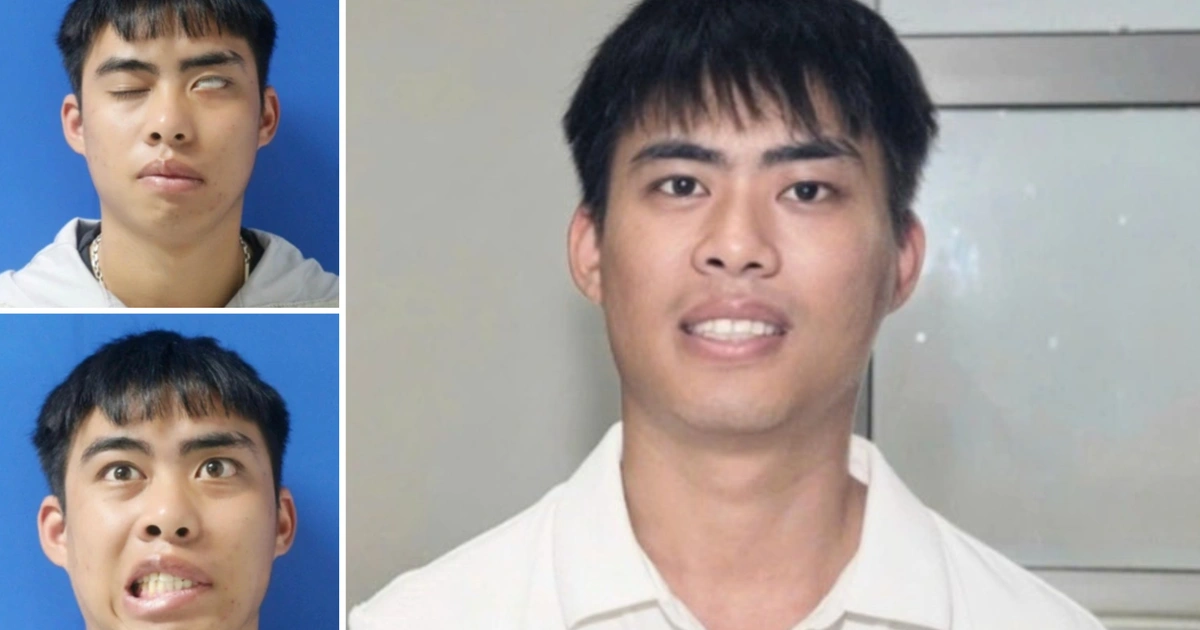 Vi phẫu liệt mặt mạn tính: từ 7 năm bất động đến nụ cười tự nhiên