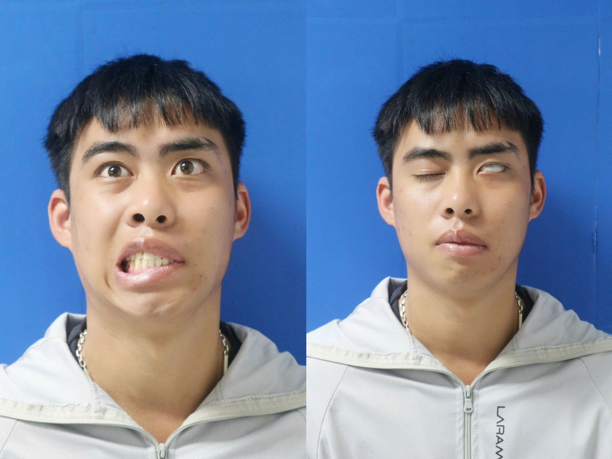Từ 7 năm liệt mặt đến nụ cười tự nhiên