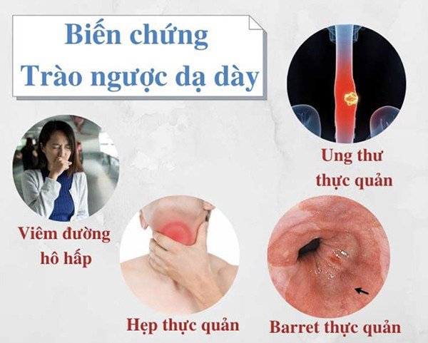 Trào ngược dạ dày: Hiểu đúng nguyên nhân, điều trị mới hiệu quả