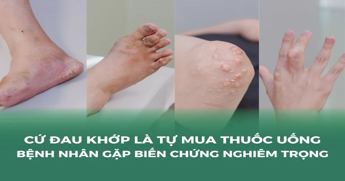 Uống thuốc giảm đau tùy tiện: con đường ngắn nhất dẫn đến tổn thương gan