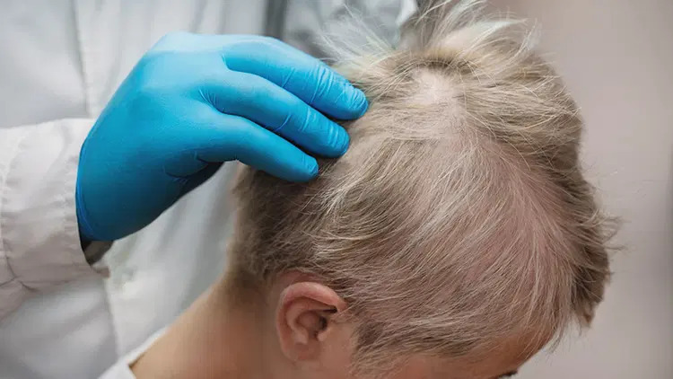 Từ thuốc viêm khớp đến công nghệ AI: cuộc chơi mới trong điều trị rụng tóc