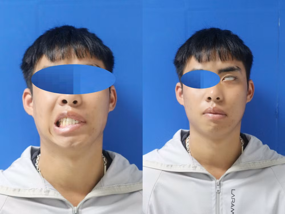 Từ 7 năm liệt mặt đến nụ cười tự nhiên nhờ vi phẫu thần kinh