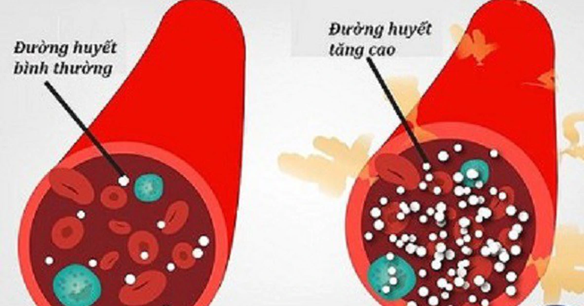Bữa sáng độc hại và nguy cơ tử vong vì tiểu đường âm thầm