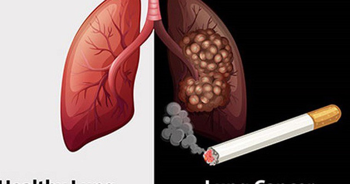 Máy CT phổ AI: Cơ hội bẻ gãy “án tử” ung thư phổi muộn