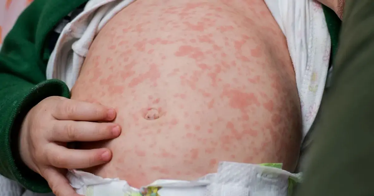 Đồng nhiễm virus và vi khuẩn ở trẻ nhỏ: Đừng xem thường cơn sốt đầu mùa