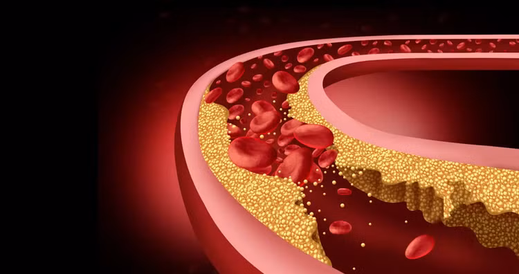 Liệu pháp chỉnh sửa gen CRISPR hạ cholesterol lâu dài