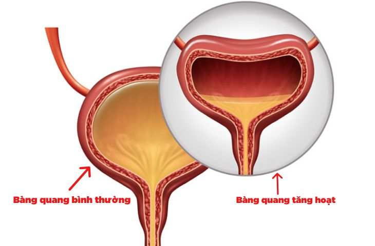 Uống nước lá tía tô đúng cách để không hại bàng quang