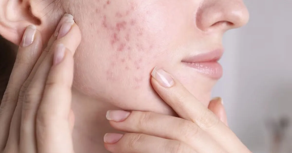 Vị trí mụn trên mặt tiết lộ nguyên nhân thực sự