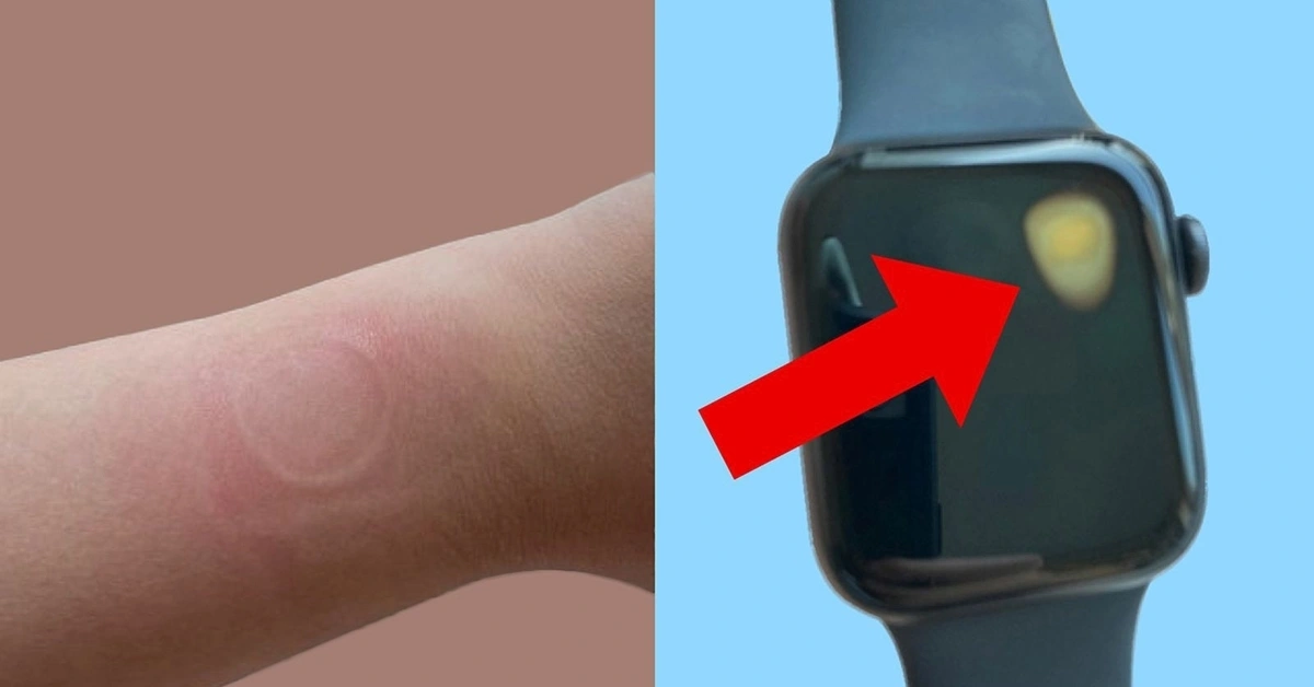 Apple Watch phát hiện bệnh tim và ung thư: cứu tinh hay rủi ro trên cổ tay?