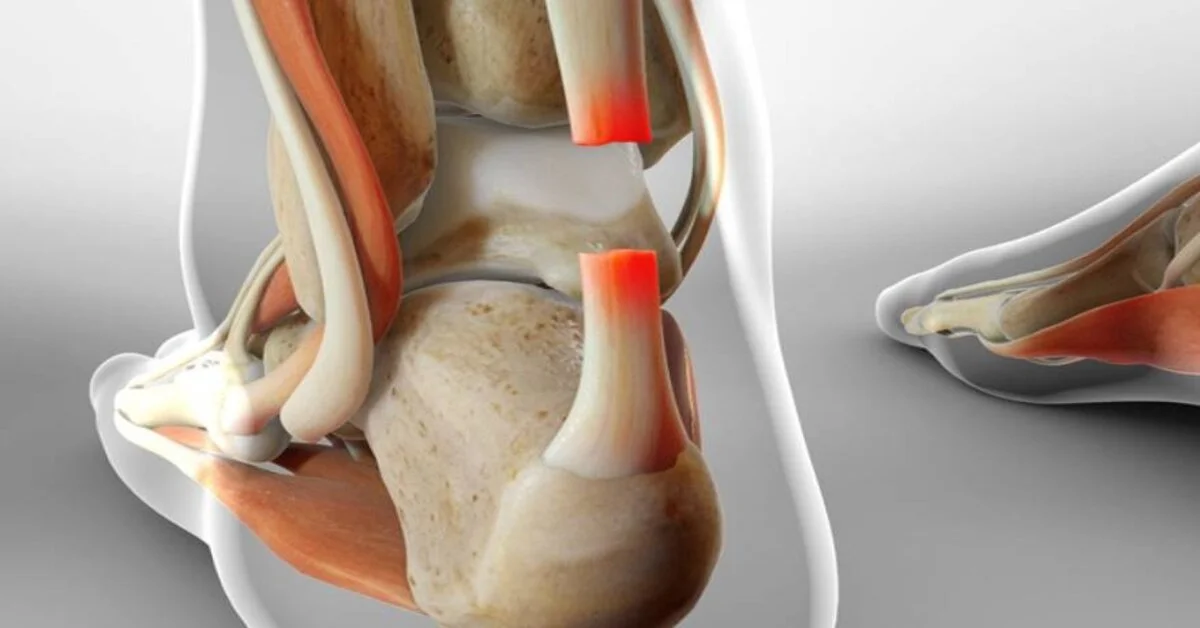 Viêm gân Achilles ở runner: Nhận biết sớm, phòng ngừa và phục hồi an toàn