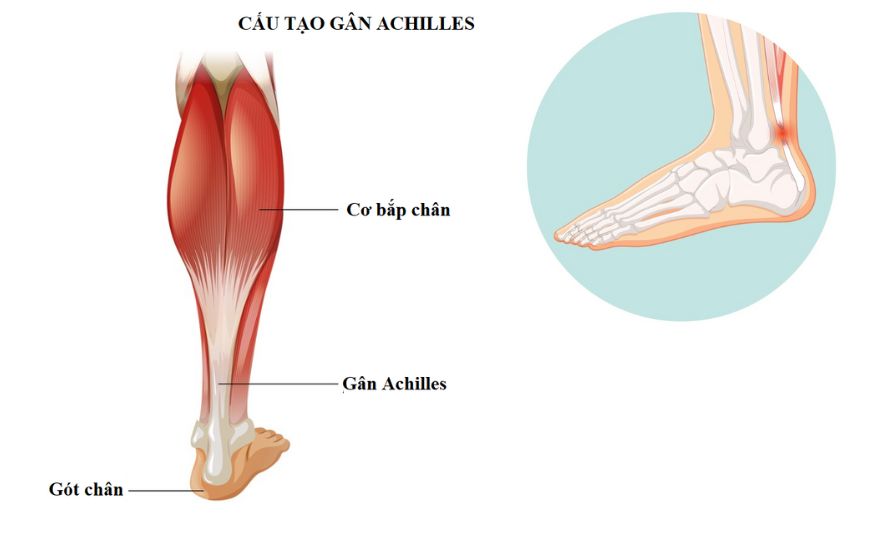 Viêm gân Achilles ở runner: Nhận biết sớm, phòng ngừa và phục hồi an toàn