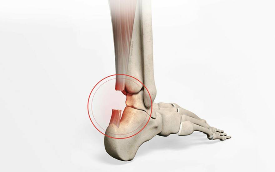 Viêm gân Achilles ở runner: Nhận biết sớm, phòng ngừa và phục hồi an toàn