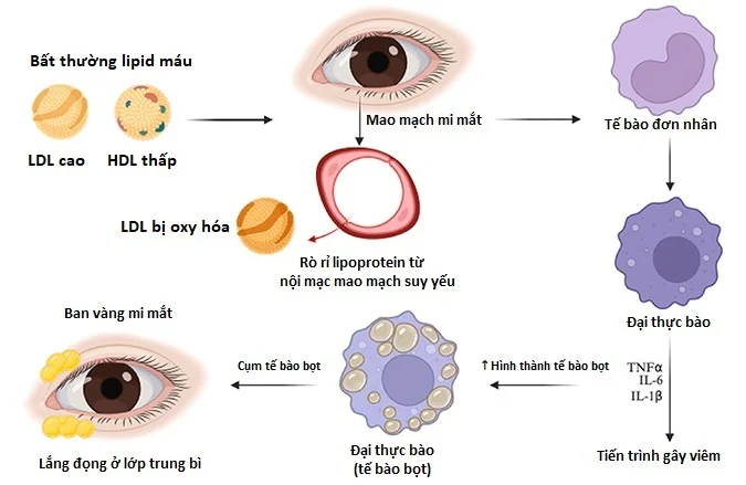 Đau đầu, nhìn mờ: dấu hiệu đột quỵ sớm dễ bị bỏ qua