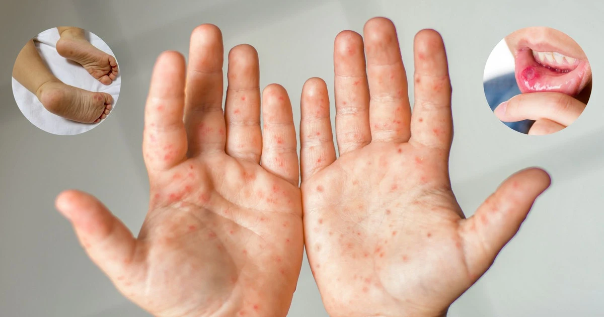 Bệnh tay chân miệng bùng phát mùa khai giảng: phụ huynh và nhà trường không được phép chủ quan