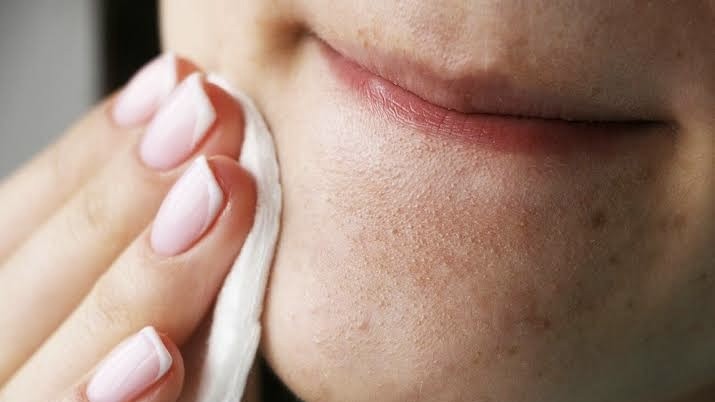 Mụn đầu đen tái phát liên tục: 5 thói quen bạn phải bỏ ngay