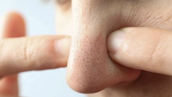 Mụn đầu đen tái phát liên tục: 5 thói quen bạn phải bỏ ngay