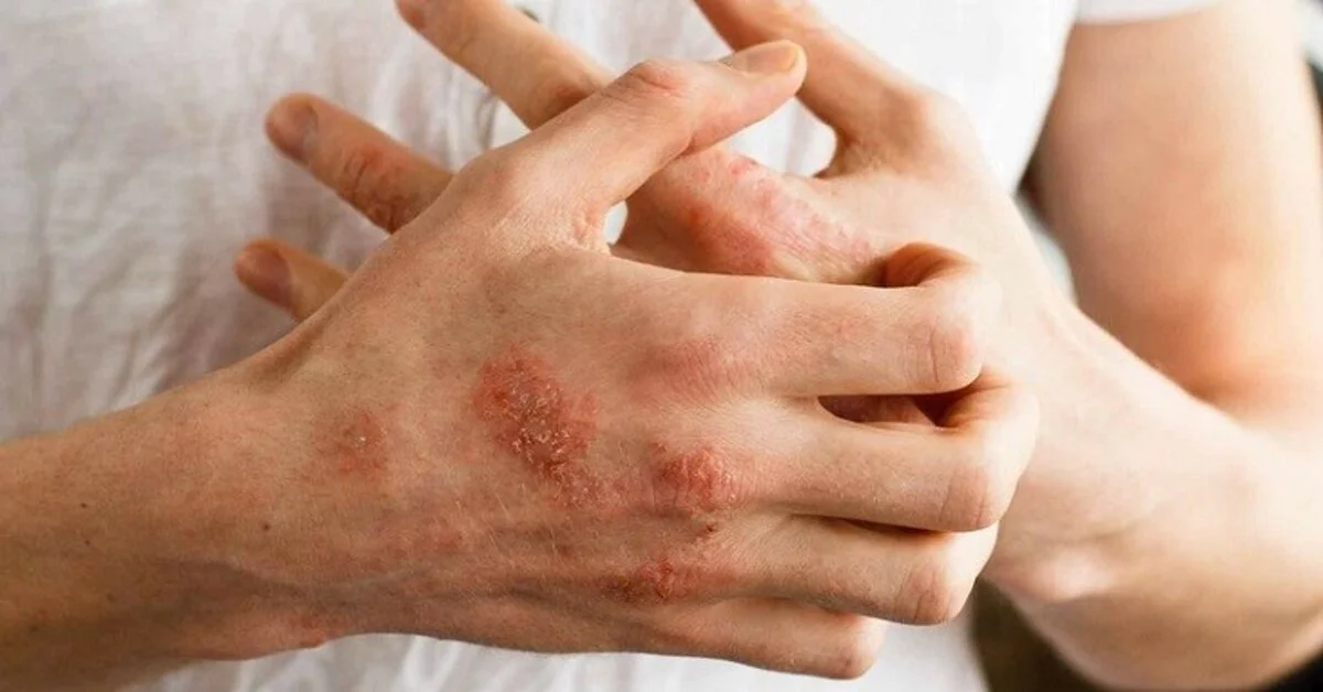 Viêm da cơ địa: So sánh chăm sóc da, thuốc và liệu pháp tiêm mới