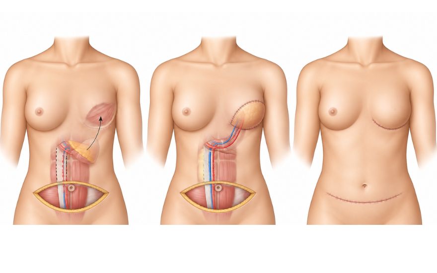 Tái tạo vú tức thì: điều trị ung thư và phục hồi thẩm mỹ trong một ca mổ