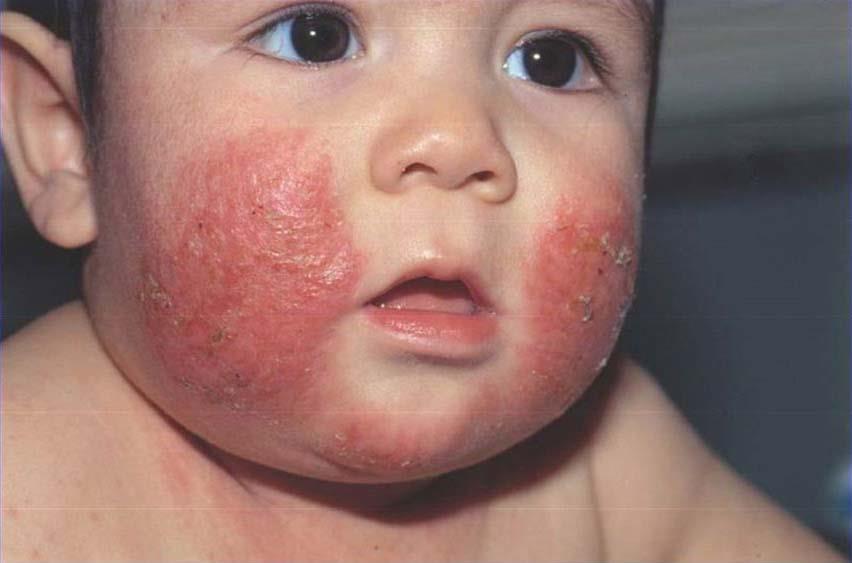 Viêm da cơ địa: So sánh chăm sóc da, thuốc và liệu pháp tiêm mới