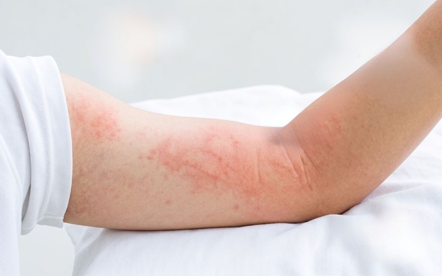 Tại sao sốt xuất huyết vẫn nguy hiểm khi đã hạ sốt