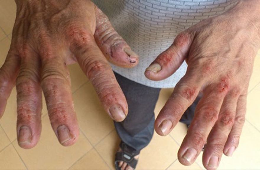 Viêm da tiếp xúc hay da nhạy cảm: phân biệt để chăm đúng