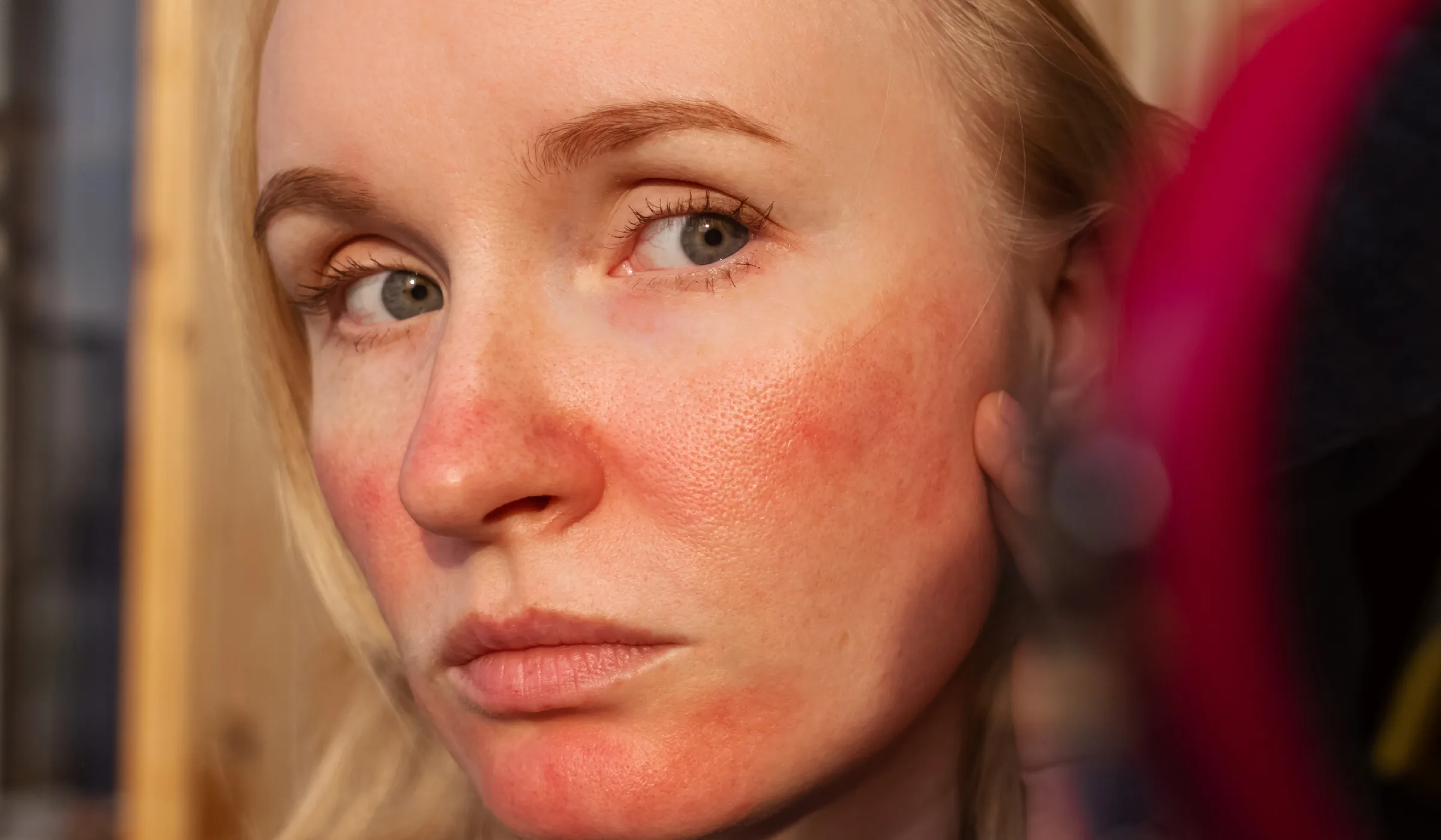 Bác sĩ da liễu chia sẻ giải pháp thực tế giúp kiểm soát rosacea hiệu quả
