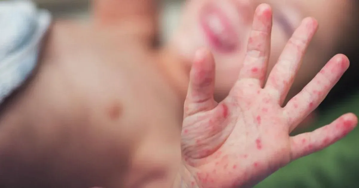 Tay chân miệng gia tăng: Cha mẹ cần làm gì để bảo vệ trẻ?