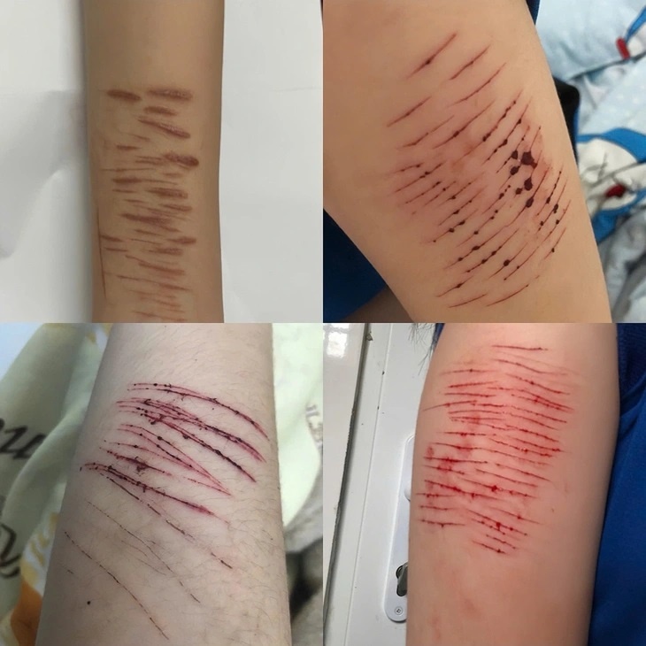 Mạng xã hội và hành vi tự gây thương tích ở thanh thiếu niên