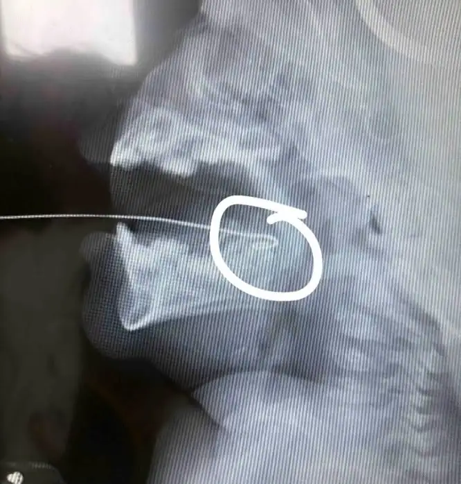 Dị vật nuốt phải từ đồ chơi: Dấu hiệu cảnh báo và cách cha mẹ phải thay đổi