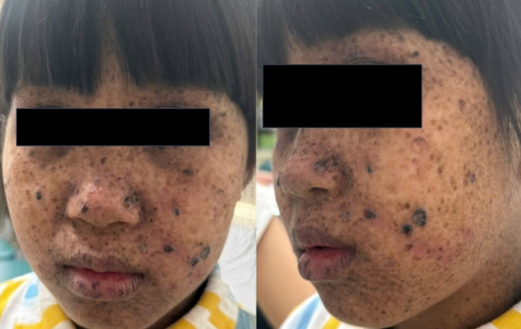 Những dấu hiệu sớm của ung thư da ở trẻ em: Khi tàn nhang và vết đen không còn “vô hại”