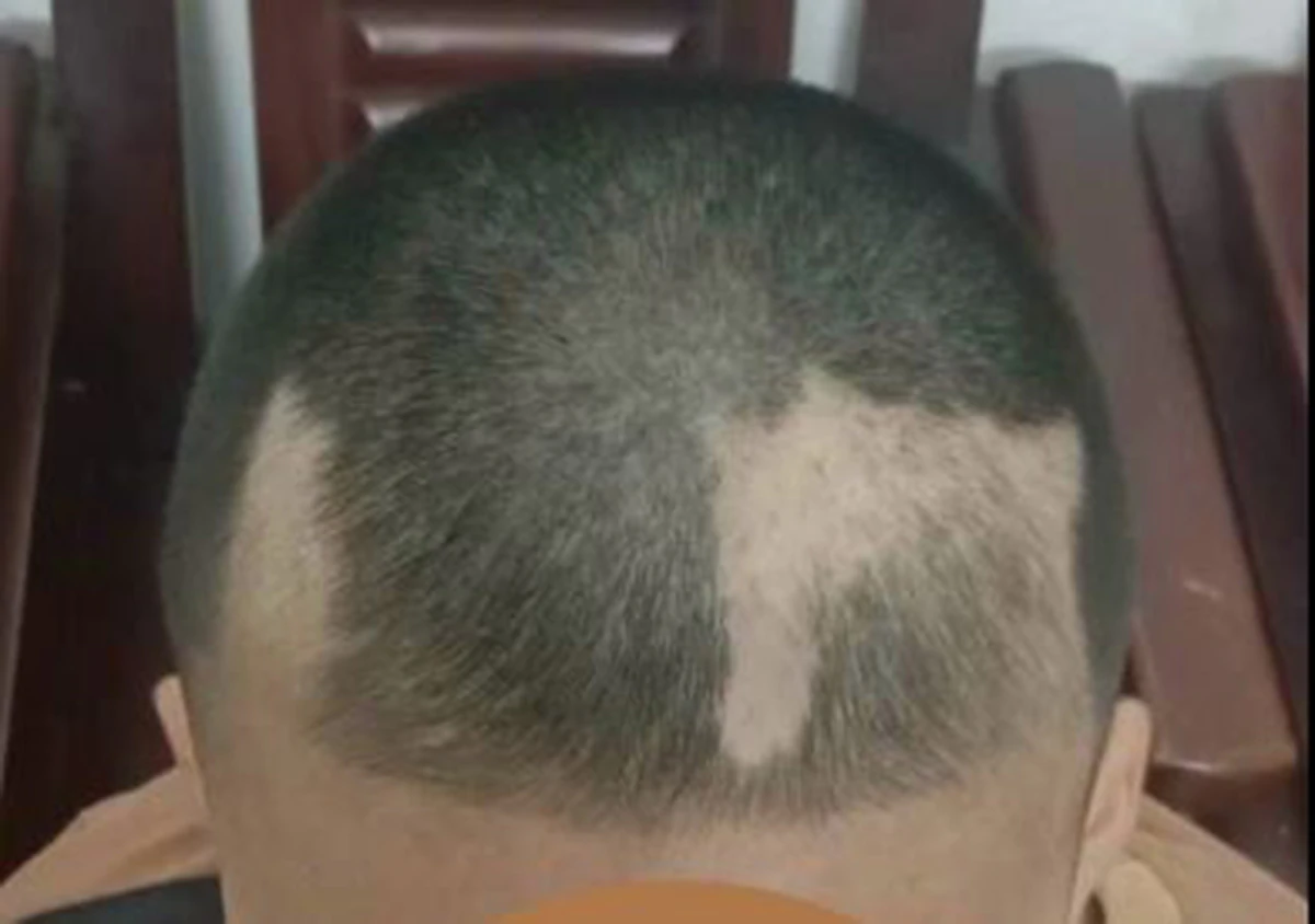 Đau đầu, nhổ tóc và những tiếng kêu cứu thầm lặng của áp lực học tập ở trẻ